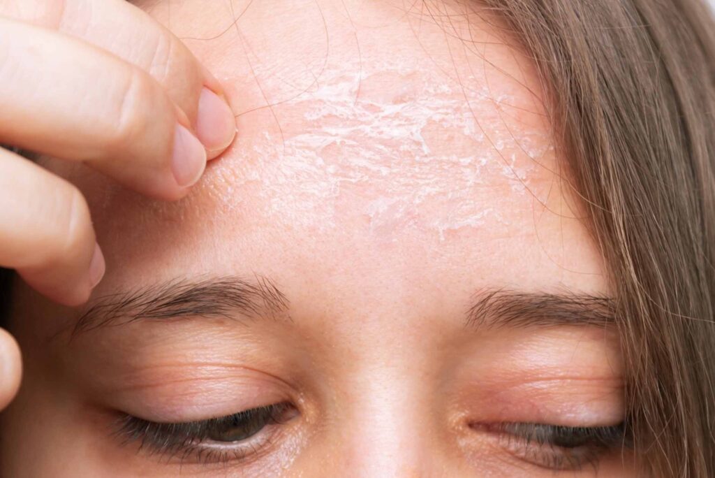 Cold Weather and Skin Health