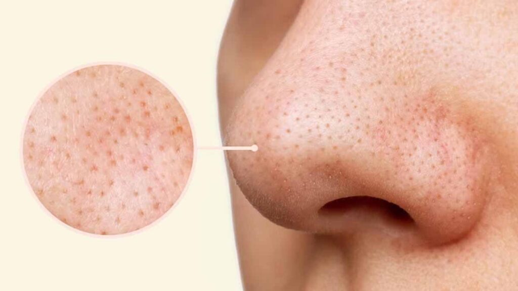 Scrub Remove Blackheads